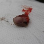 Palec w chusteczce, a pacjent czeka