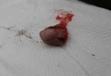 Palec w chusteczce, a pacjent czeka