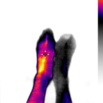 Nieleczona stopa cukrzycowa grozi amputacją