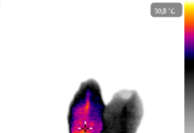 Nieleczona stopa cukrzycowa grozi amputacją