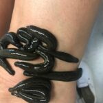 Pijawki i akupunktura – alternatywne metody leczenia coraz popularniejsze