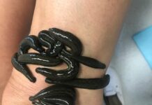 Pijawki i akupunktura – alternatywne metody leczenia coraz popularniejsze